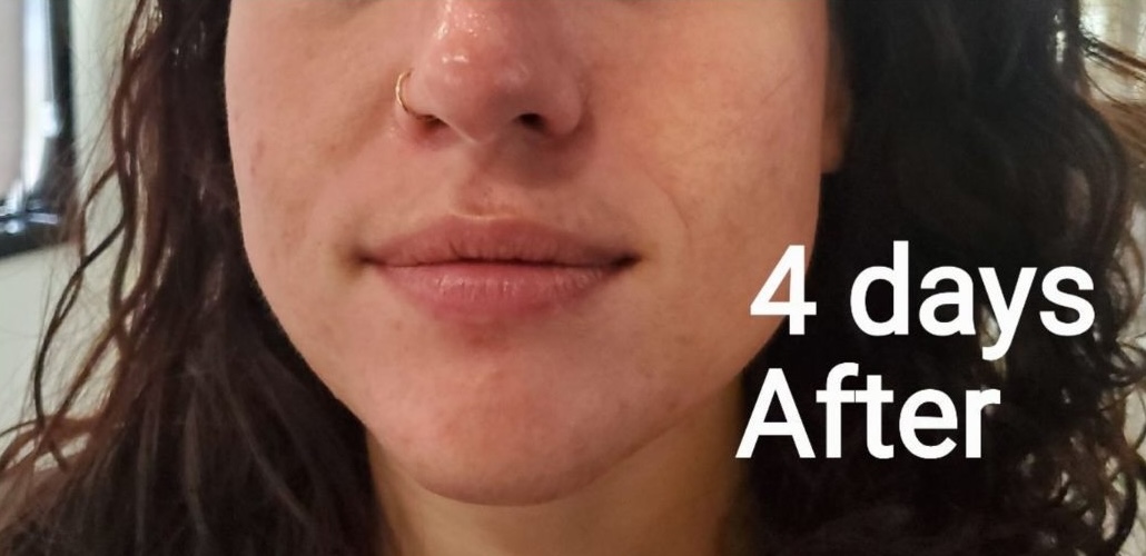 Client's skin after a Geneo Glo2Facial at Uptown Haven Wellness in Fargo