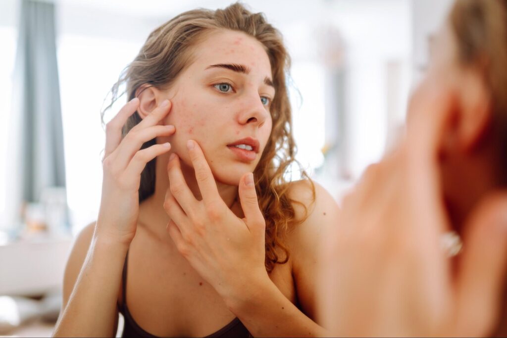 Woman examining acne breakouts in the mirror, considering facial treatments.