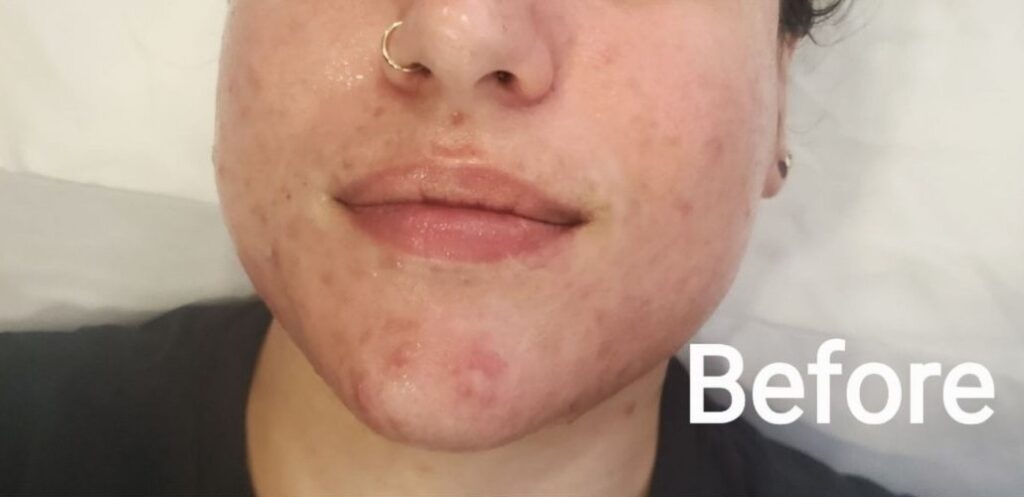 Before photo showing acne and inflammation on a client’s face.