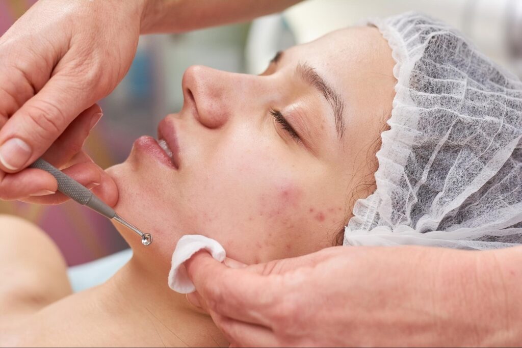 Close-up photo of a woman receiving an acne facial treatment at a professional spa in Fargo ND
