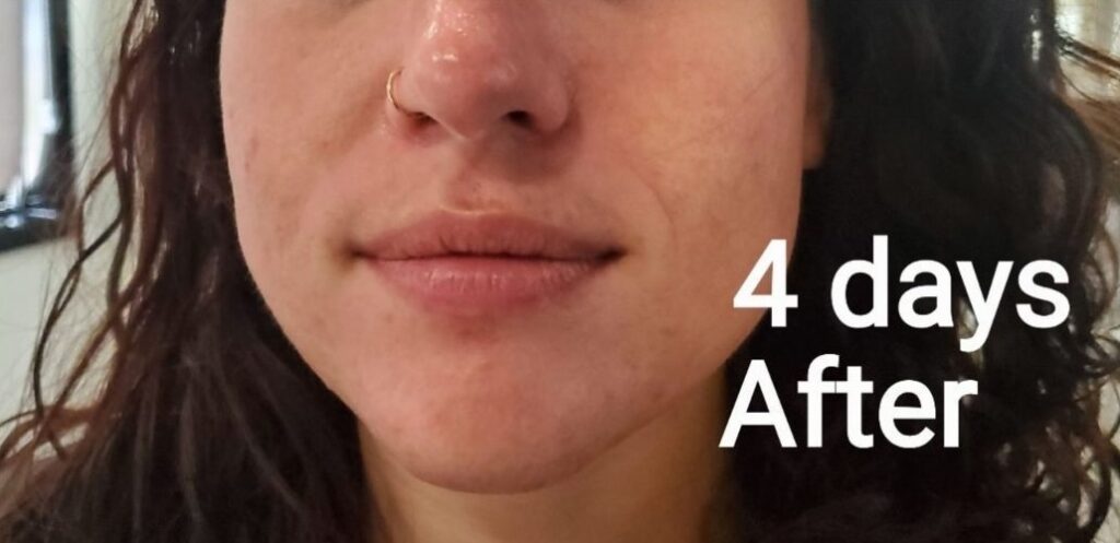 After 4 days post-acne facial treatment showing visible skin improvement.
