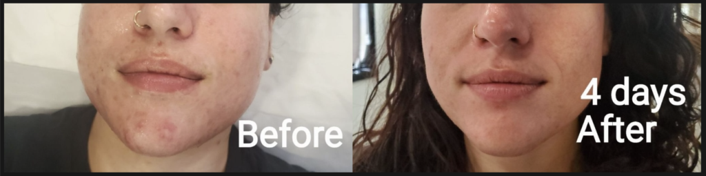 Glo2Facial Before & After