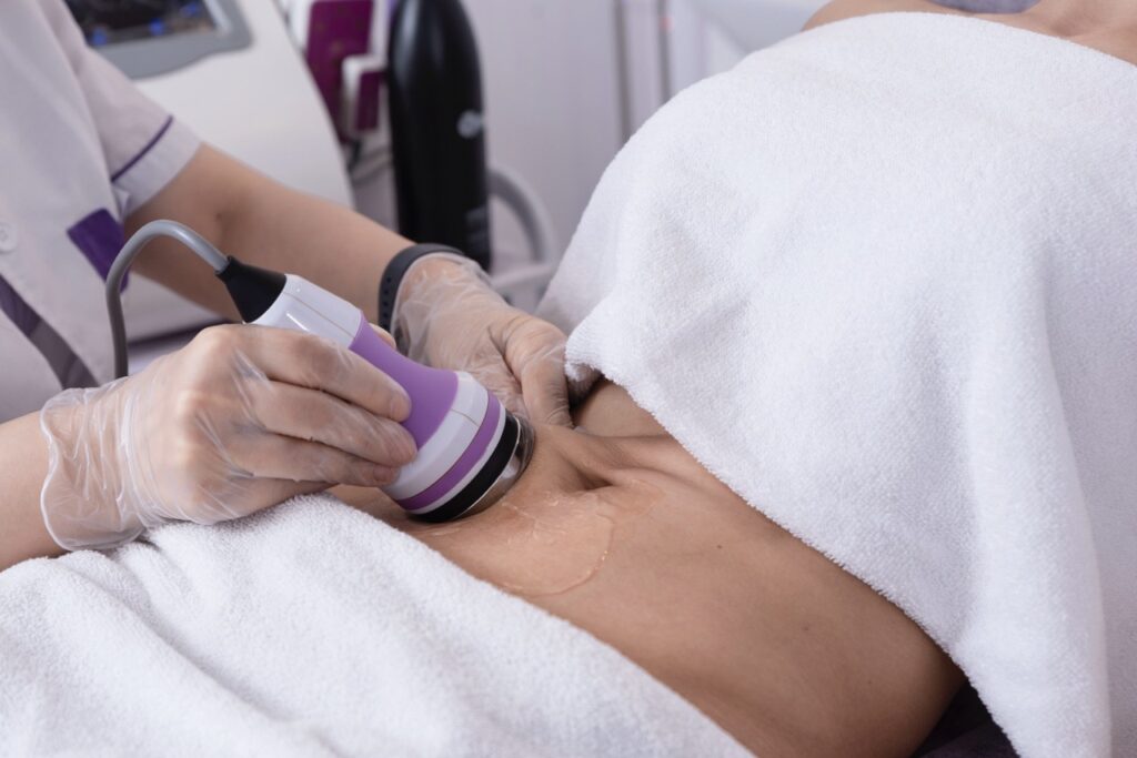 RF cavitation body contouring treatment in Fargo