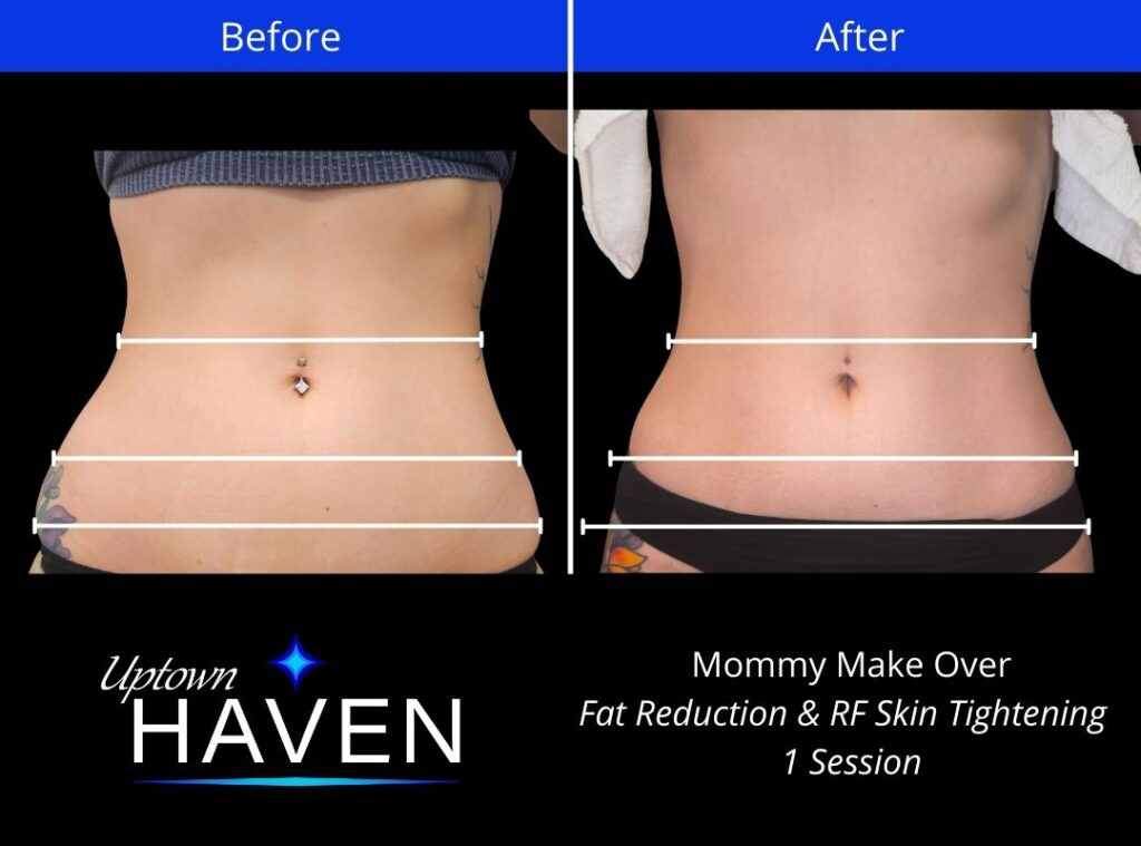 Mommy makeover RF skin tightening before and after comparison
