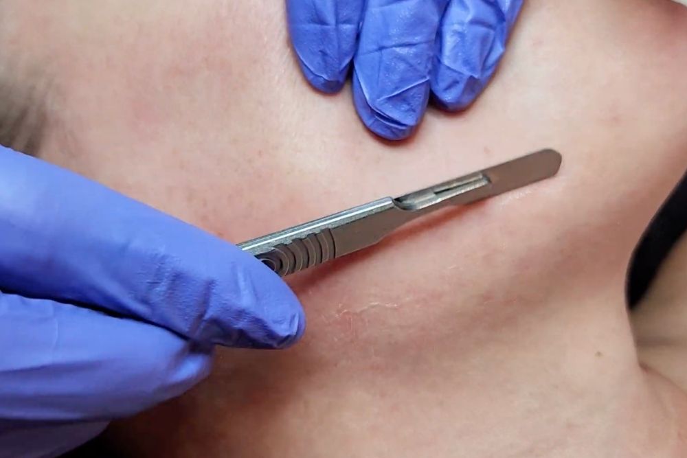 Close-up of a sterile surgical blade used during a professional dermaplaning session in Fargo.