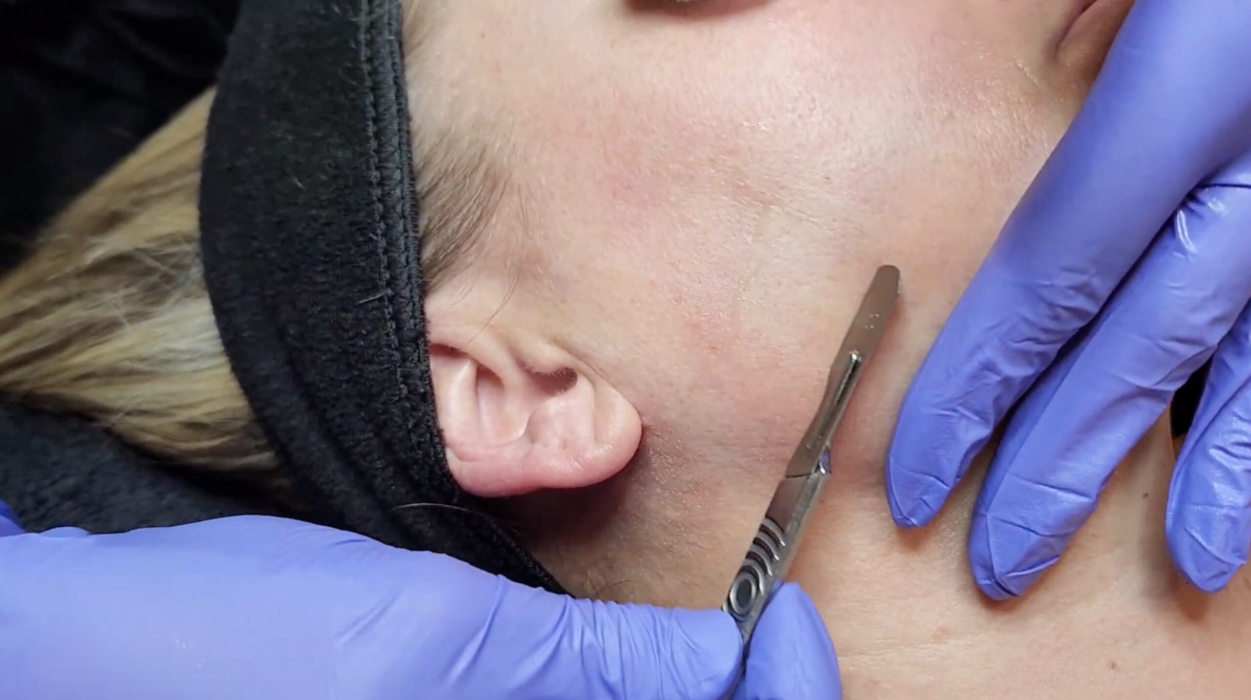 Dermaplaning treatment at Uptown Haven Wellness in Fargo, North Dakota